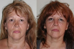 6. Rhinoplasty - Front View