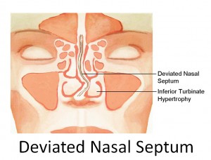 Deviated Nasal Septum