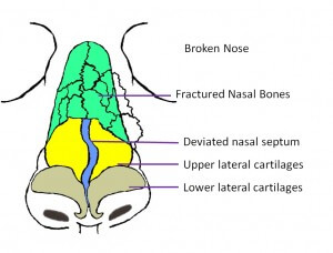 Broken Frontal Nasal Bones