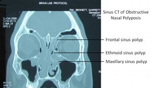 CT Scan of Frontal Sinus Polyps