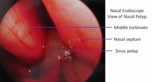 Photograph of a Nasal Polyp