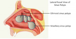 Lateral View of Nasal Polyps