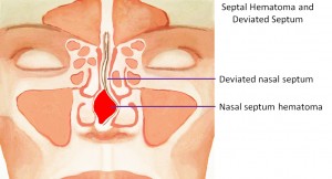 Deviated Septum and Septal Hematoma