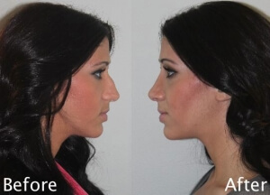cosmetic rhinoplasty before and after