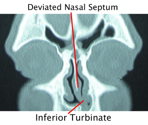 deviated septum surgery catscan