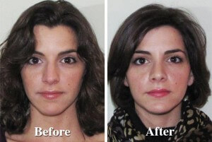 rhinoplasty-before-after