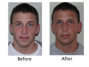 what is a rhinoplasty