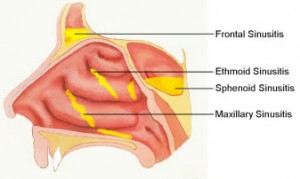 Side view of the areas generally effected by the procedure