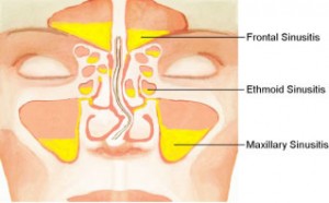 Symptoms of Sinusitis