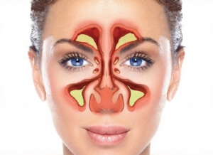 balloon sinuplasty infected frontal sinus repair