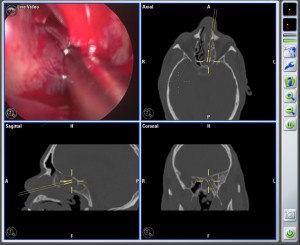 53yo female BrainLAB screen