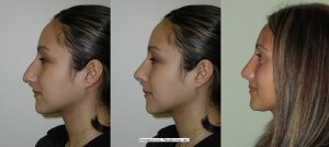 Computer Imagaing for Rhinoplasty