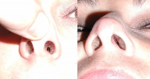 Scar Tissue (Before and After)