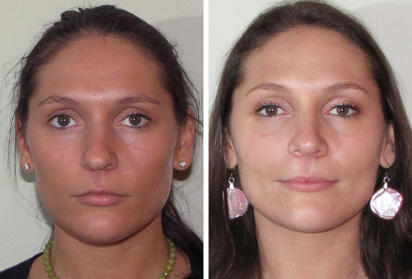 Female Rhinoplasty