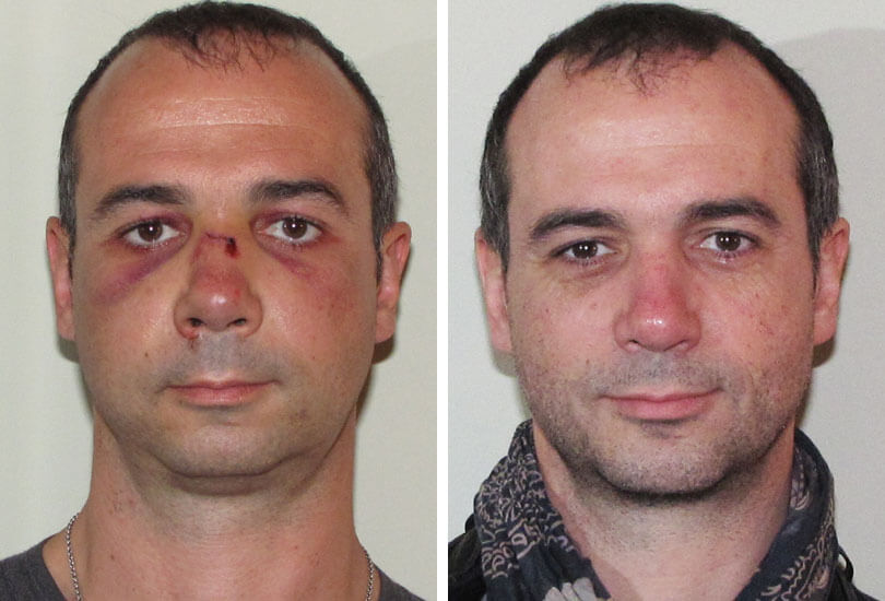 Male Fractured Nose & Septum