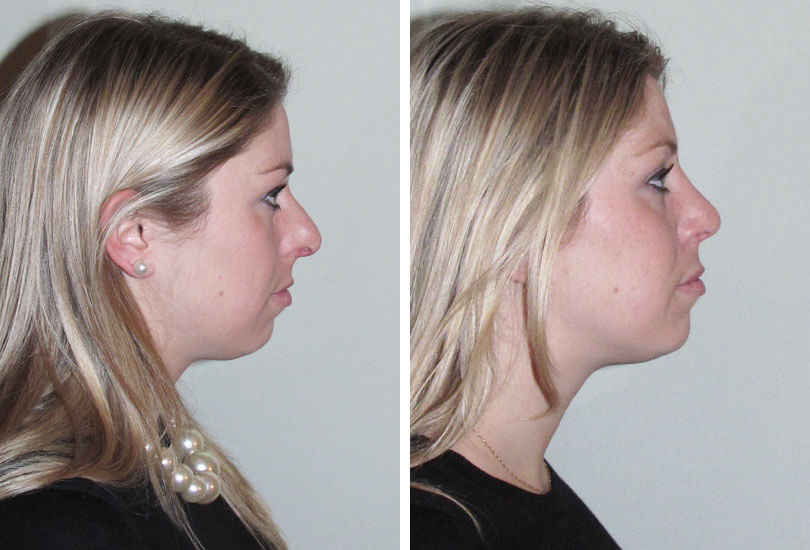 Female Rhinoplasty