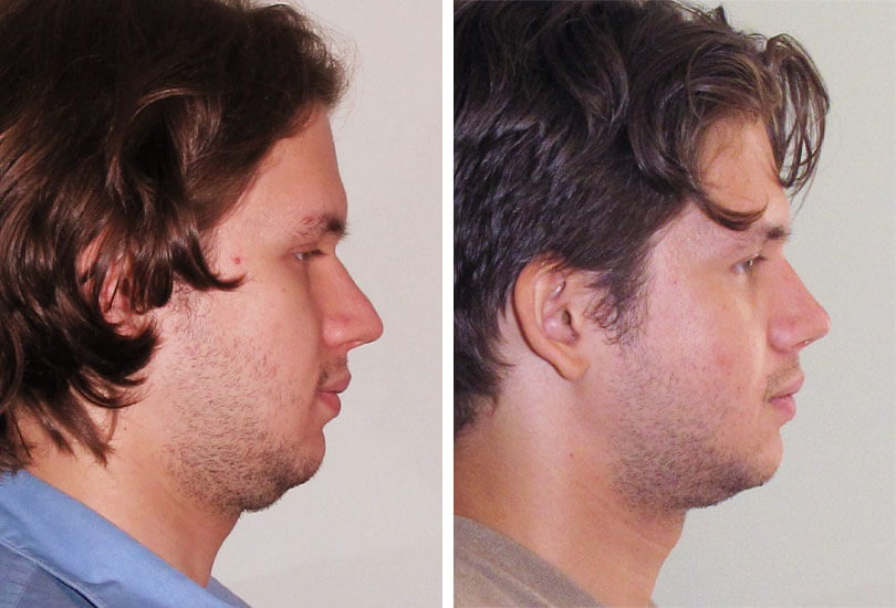 Male Fractured Nose & Septum