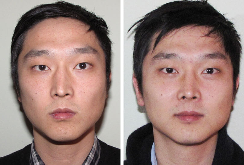 Male Rhinoplasty