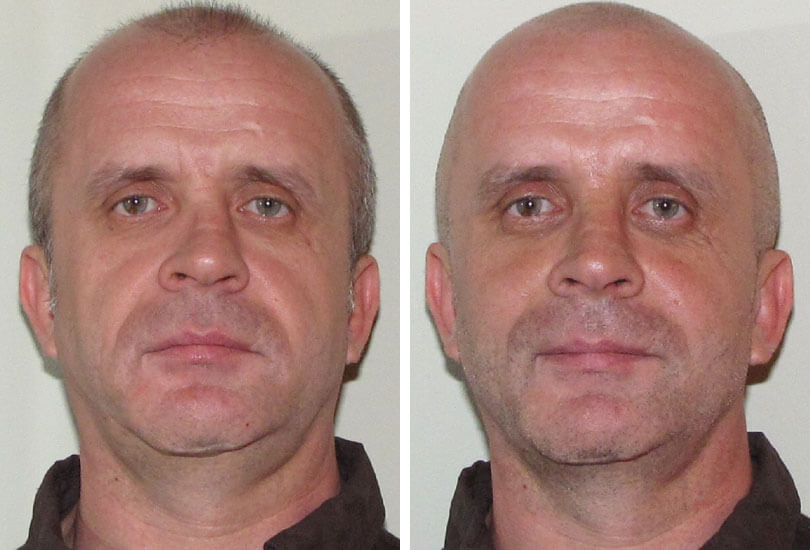 Male Rhinoplasty/Septoplasty
