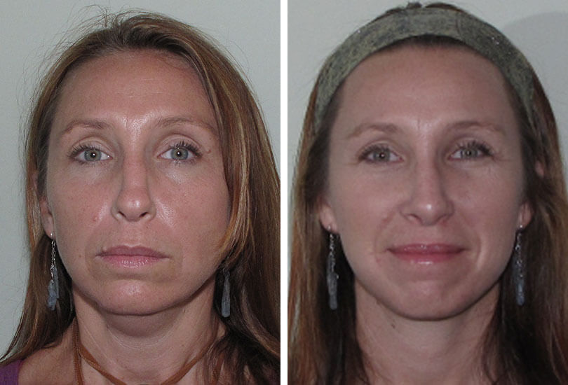 Female Rhinoplasty