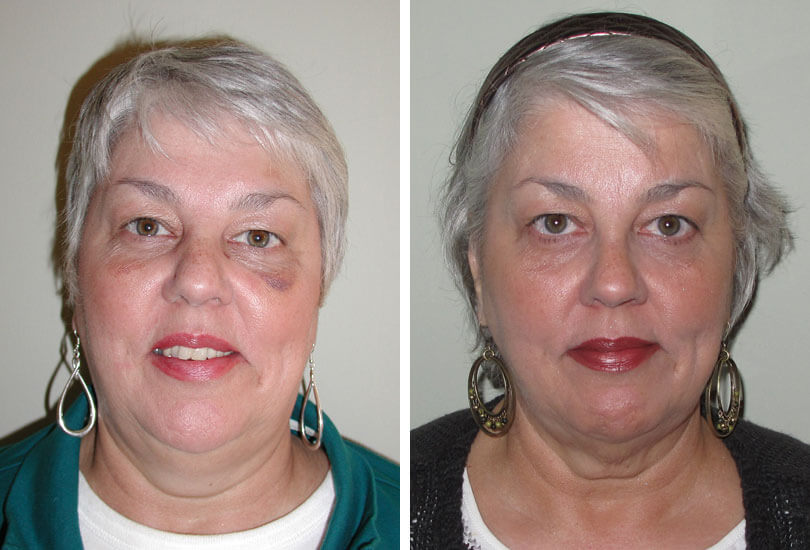 Female Rhinoplasty