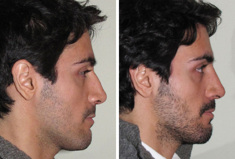 Male Rhinoplasty