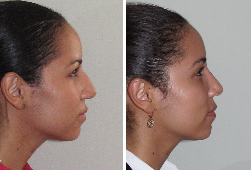 Female Rhinoplasty