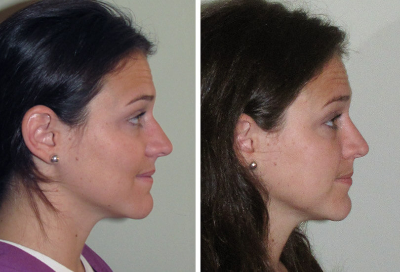 Female Rhinoplasty