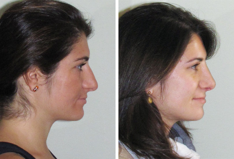 Female Rhinoplasty