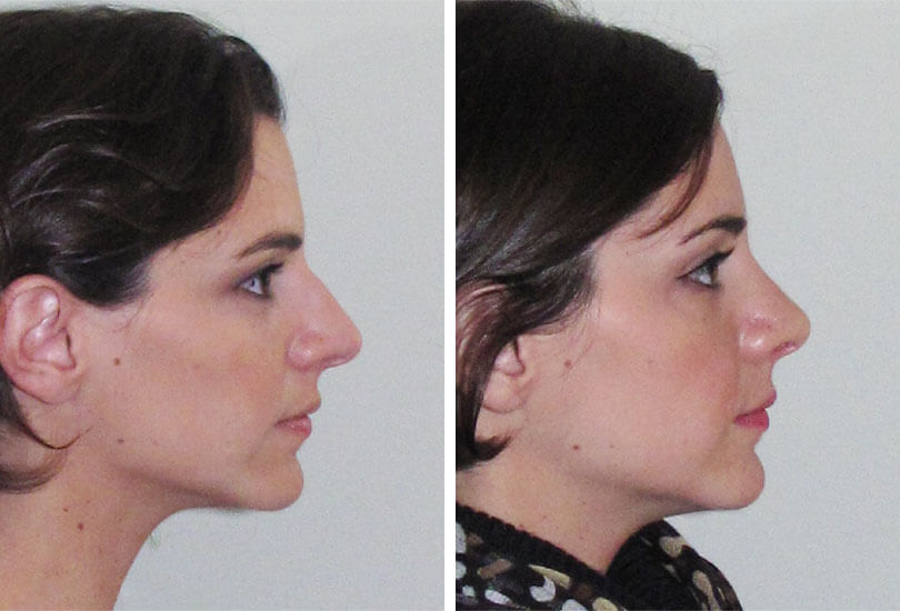 Female Rhinoplasty