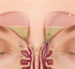 A balloon helps the sinuses drain properly