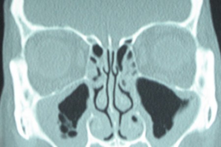 Sinus CAT Scan
