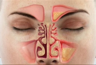 Sinusitis