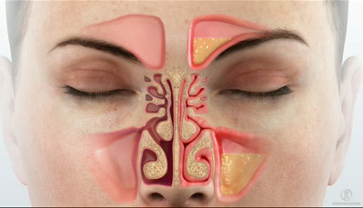 Sinusitis