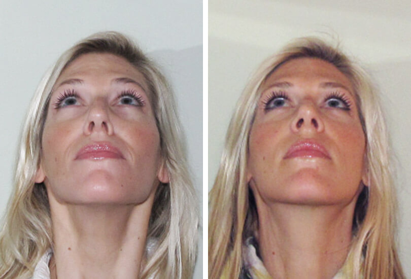 Female Rhinoplasty