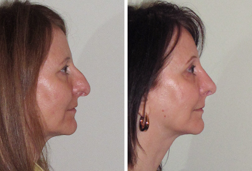 Female Rhinoplasty
