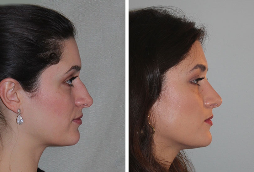 Female Rhinoplasty