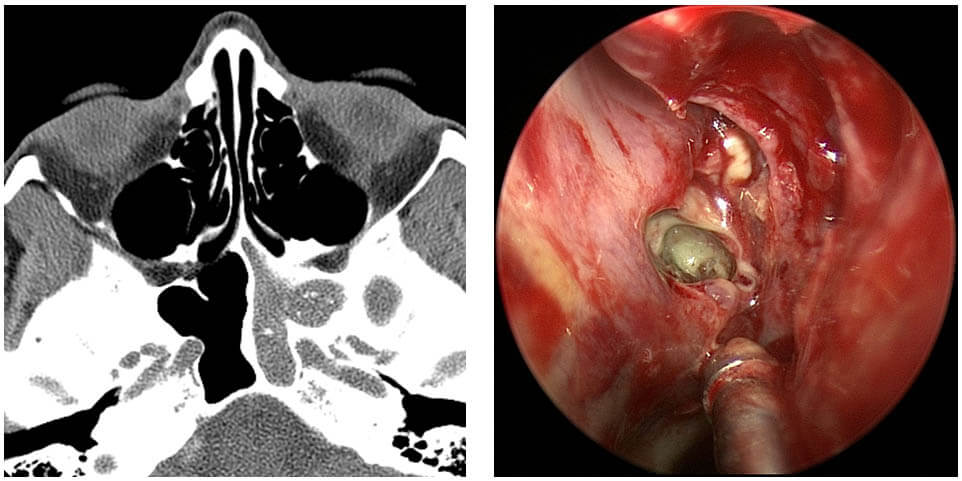 Fungal Sinus Infection