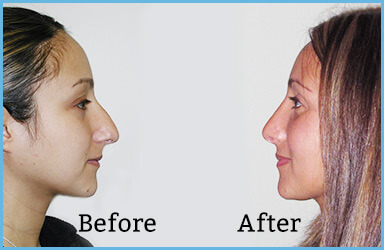before-after nose surgery gallery