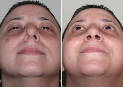 Male Septoplasty