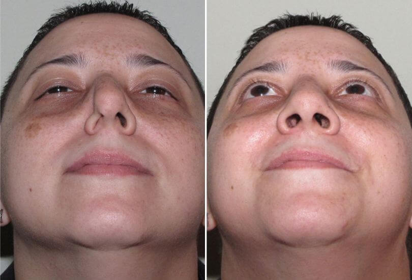 patient_2_nasal_valve_collapse