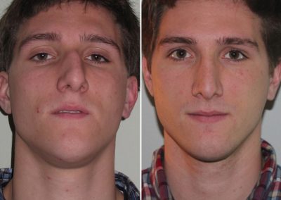 Male Fractured Nose & Septum
