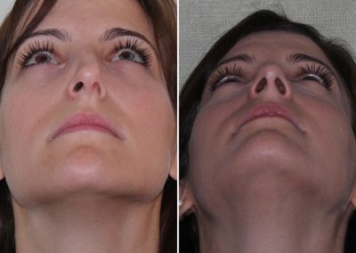 Female Fractured Nose & Septum