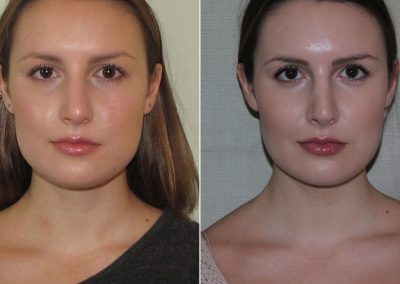 Female Septoplasty