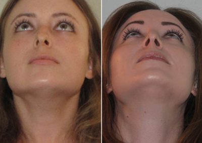 Female Septoplasty