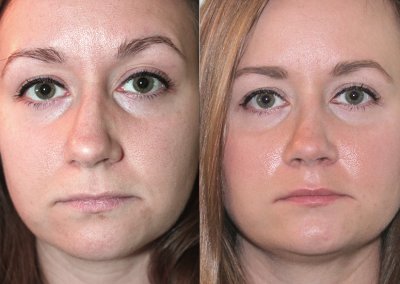 Female Septoplasty NYC