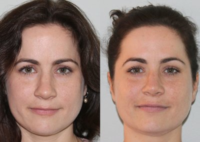 Female Sinus Surgery