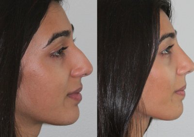 Female Sinus Surgery