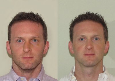Male Fractured Nose & Septum