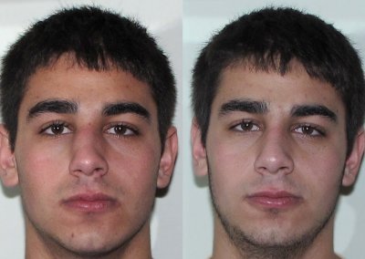 Male Fractured Nose and Septum